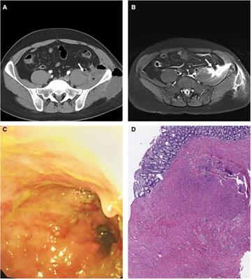 Intestinal neuronal dysplasia presenting as psoas abscess: A case report